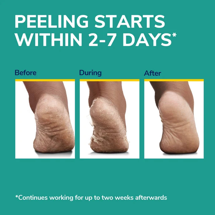 Foot mask peeling timeline showing heel “before,” “during,” and “after” results