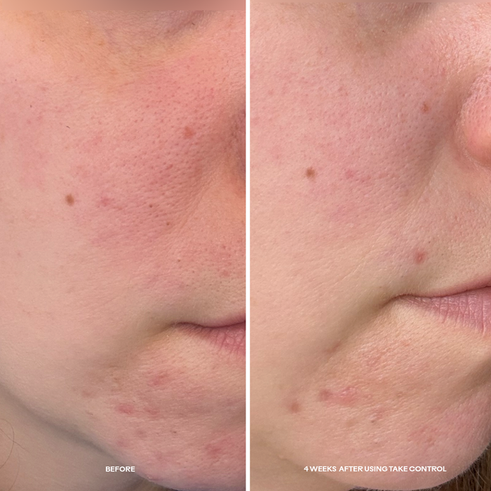 Three Ships-Take Control™ Salicylic + 10% Azelaic Acid Clarifying Serum-Skincare-990478500327_TakeControl_Salicylic_10_AzelaicAcidClarifyingSerum__5_BeforeAfter-The Detox Market |